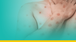 Casos de mpox dobram em poucas semanas e acendem alerta no Brasil