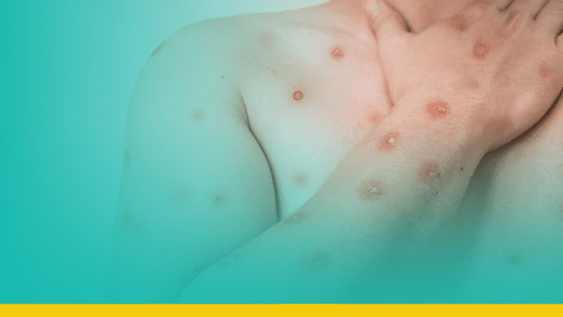 Casos de mpox dobram em poucas semanas e acendem alerta no Brasil
